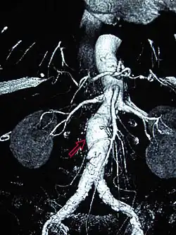 Abdominal aortic aneurysms (3.4&nbsp;cm)