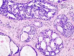 Ductal carcinoma in situ (DCIS) in breast tissue, cell nuclei (blue-purple), extracellular material (pink)