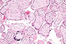 Micrograph of CMV placentitis