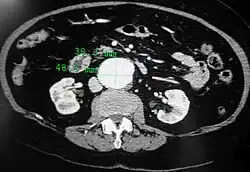 An axial contrast-enhanced CT scan demonstrating an abdominal aortic aneurysm of 4.8 by 3.8&nbsp;cm