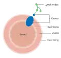 Dukes stage C bowel cancer; the cancer has invaded the nearby lymph nodes.