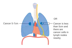 Stage IIA lung cancer