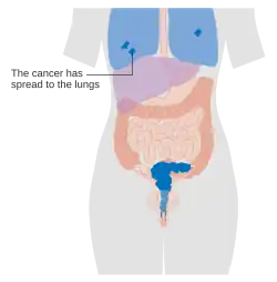 Stage 4B cervical cancer
