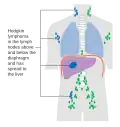 Stage 4 Hodgkin lymphoma