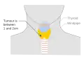 Stage T1b thyroid cancer