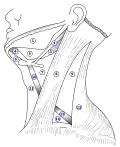The triangles of the neck. (Anterior triangles to the left; posterior triangles to the right. Suprahyoid labeled at left.)