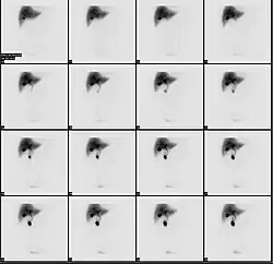 Normal hepatobiliary scan (HIDA scan). The nuclear medicine hepatobiliary scan is clinically useful in the detection of the gallbladder disease.