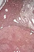 Micrograph of hepatic adenoma. Reticulin stain