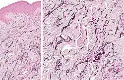 Histopathology: Accumulation of fragmented elastotic material within the papillary dermis and transcutaneous elimination of elastotic fibers.[5]