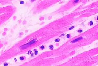 Neutrophils are seen in a myocardial infarction at approximately 12–24 hours,[67] as seen in this micrograph.