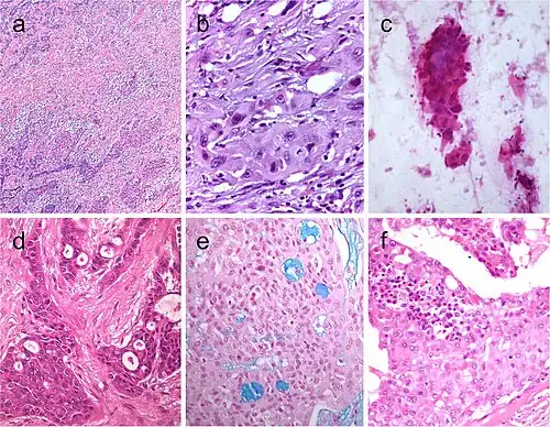 Squamous cell tumor examples that include extensive squamous metaplasia in PTC after fine needle aspiration biopsy (FNAB) (a), squamous cell carcinoma in the thyroid of putative secondary origin (b), and squamous cell carcinoma of the esophagus metastatic in the thyroid and diagnosed by FNAB (c). Mucoepidermoid carcinoma (d) composed by solid sheets of epithelial cells showing epidermoid cells and glandular spaces containing mucinous material positively stained with Alcian blue (e). Sclerosing mucoepidermoid carcinoma with eosinophilia showing epithelial cells richly infiltrated by eosinophils, lymphocytes, and plasma cells (f)[9]
