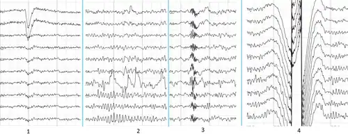 Common artifacts in human EEG. 1: Electrooculographic artifact caused by the excitation of eyeball's muscles (related to blinking, for example). Big-amplitude, slow, positive wave prominent in frontal electrodes. 2: Electrode's artifact caused by bad contact (and thus bigger impedance) between P3 electrode and skin. 3: Swallowing artifact. 4: Common reference electrode's artifact caused by bad contact between reference electrode and skin. Huge wave similar in all channels.