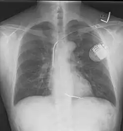 A chest film after insertion of an implantable cardioverter-defibrillator, showing the shock generator in the upper left chest and the electrical lead inside the right heart. Note both radio-opaque coils along the device lead.