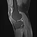 Knee MRI (PD TSE FS sagittal)