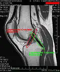 Cruciate ligaments