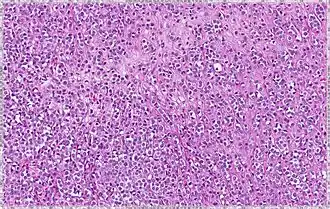 Lobular breast cancer. Single file cells and cell nests.
