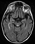 Axial MRI FLAIR image showing hyperintense signal in the periaqueductal gray matter and tectum of the dorsal midbrain