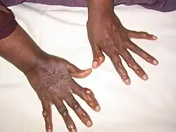 Multiple nodules on the hands of an adult