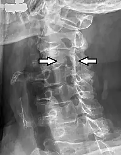 Projectional radiograph of a man presenting with pain by the nape and left shoulder, showing a stenosis in the intervertebral foramen of cervical spinal nerve 4, corresponding with the affected dermatome.