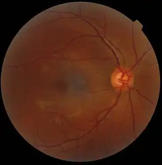 A fundus photograph showing the macula as a spot to the left. The optic disc is the area on the right where blood vessels converge. The grey, more diffuse spot in the centre is a shadow artifact.