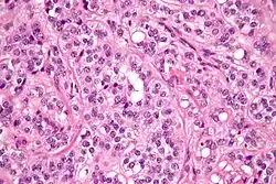 High magnification micrograph of a Sertoli cell tumour. H&E stain.