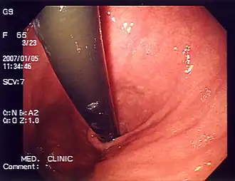 Endoscopic photo of the stomach
