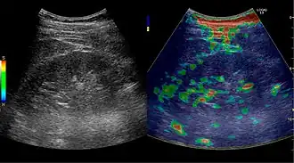 Figure 32. Strain elastography of a normal kidney. Red depicts soft areas, and blue depicts hard areas relative to the entire elastography image. Note that the medulla is softer than the cortex. A color bar is shown to the left of the image, where "S" and "H" denote soft and hard tissue, respectively.[1]