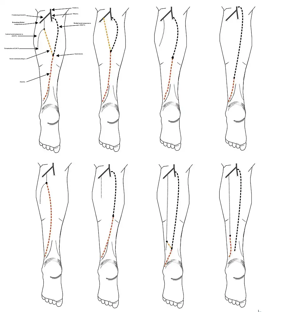 8 documented types of sural nerve formation