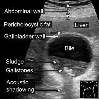 Biliary sludge and gallstones. There is borderline thickening of the gallbladder wall.