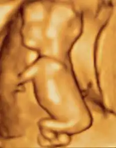 3D ultrasound of 80-millimetre (3 in) fetus (about 3+1⁄2 months gestational age)