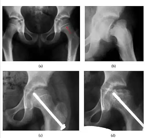 Figure 4: (a) X-ray of a 10-year-old child with left hip pain. It was considered normal at emergency despite the widening of the left physis (arrow). Two weeks later epiphysiolysis was evident (b). Despite appropriate surgical reduction (c) osteonecrosis developed and femoral head collapsed 1 month later (d).[1]