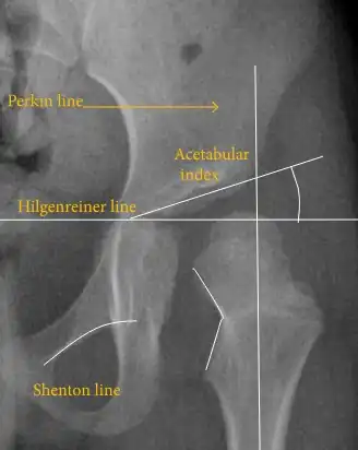 Hip dysplasia.[47]