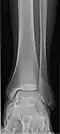 Ankle - frontal