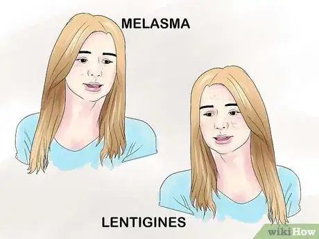 Image titled Treat Hyperpigmentation Step 1