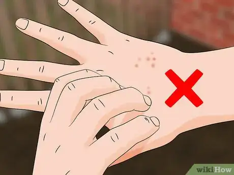 Image titled Treat Oak Mite Bites Step 1