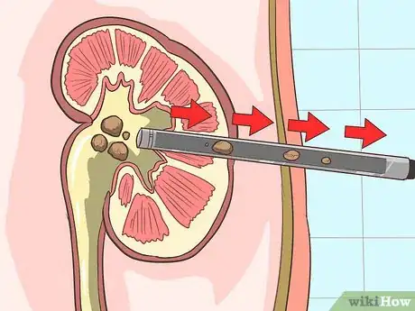 Image titled Treat Kidney Pain Step 12
