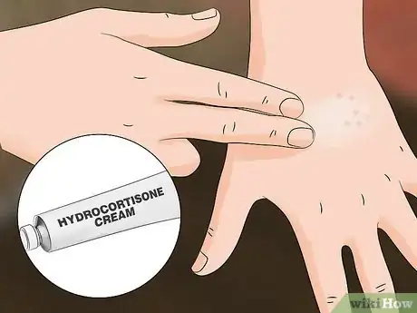 Image titled Treat Oak Mite Bites Step 3