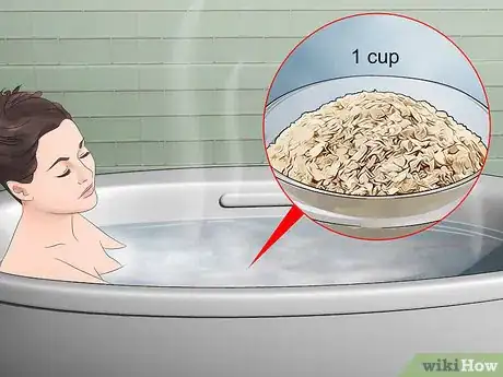 Image titled Treat Oak Mite Bites Step 5