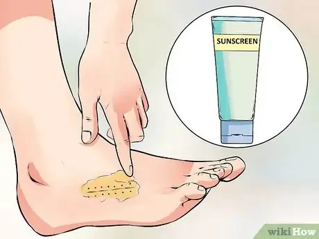 Image titled Remove Stitches Step 14