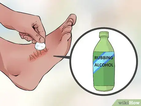 Image titled Remove Stitches Step 5