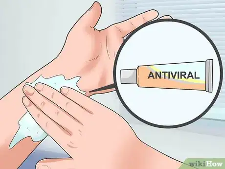 Image titled Treat Molluscum (Molluscum Contagiosum) Step 9