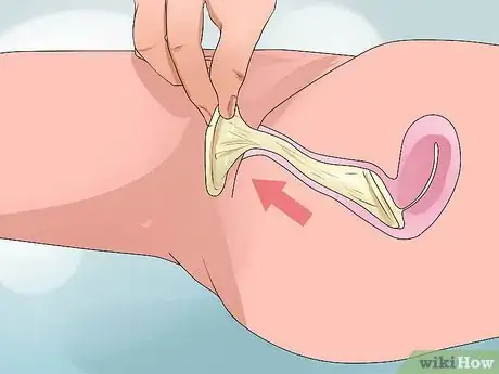 Image titled Remove a Condom Stuck Inside Step 8