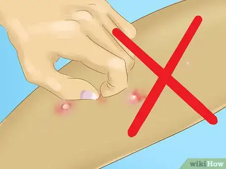 Image titled Recognize Molluscum (Molluscum Contagiosum) Step 7