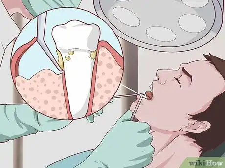 Image titled Treat Periodontal Disease Step 11
