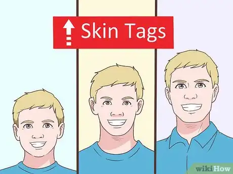 Image titled Prevent Skin Tags Step 4