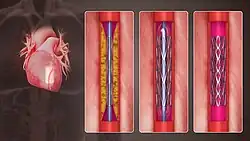 3D Medical Animation still shot of Percutaneous coronary intervention