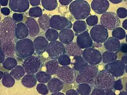 Bone marrow smear (large magnification) from a person with ALL