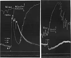 Adrenaline reversal after Henry Hallett Dale (1906). An ergot extract was injected between left-hand and right-hand tracings.