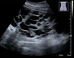 Figure 7. Advanced polycystic kidney disease with multiple cysts.[1]