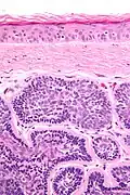 Micrograph of dermal cylindroma in H&E stain.
